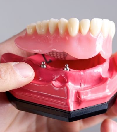 Implants & Dentures