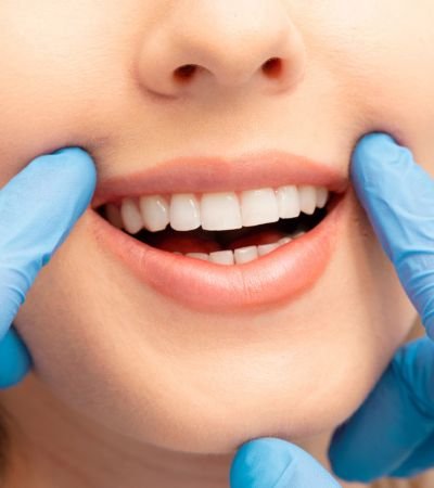 Teeth whitening