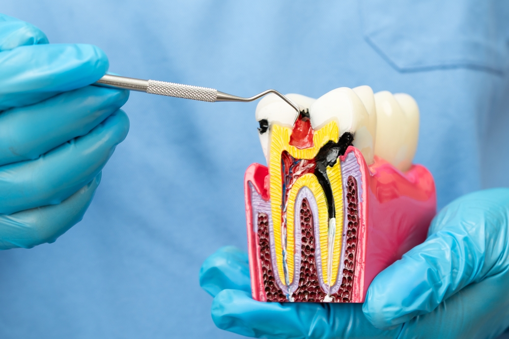 root canal in Etobicoke